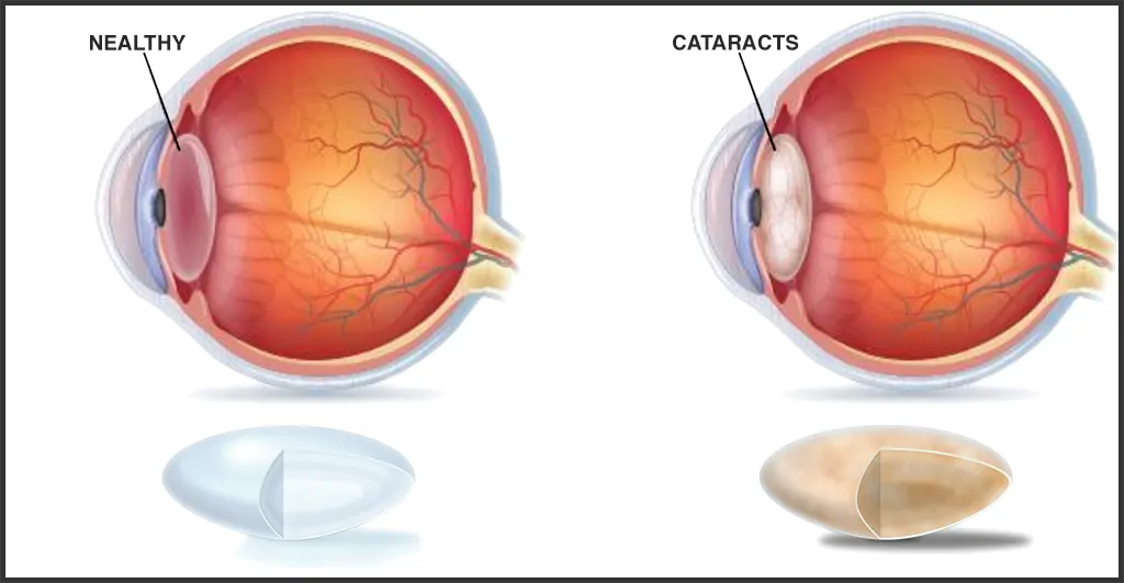 Cataracts Eye Condition